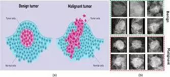 Breast Cancer Detection Using Decision Tree