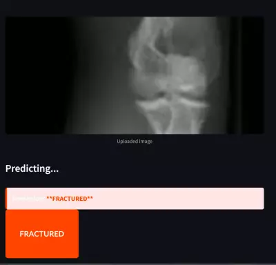 Bone Fracture Detection using Computer Vision