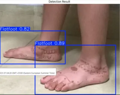 نموذج AI للكشف عن تبسط القدم - FLATFOOT DETECTION USING YOLOv8n
