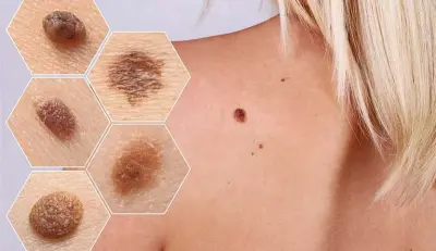 مشروع كامل في تشخيص صور سرطان الجلد