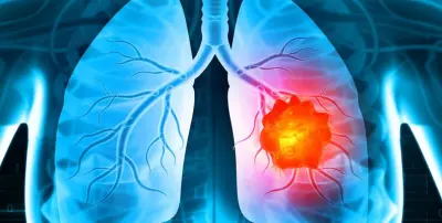 Lung Cancer Detection Model