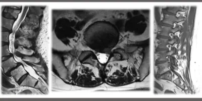 تصميم نماذج ذكاء اصطناعي لتشخيص حالات العمود الفقري من صور الرنين المغناطيسي