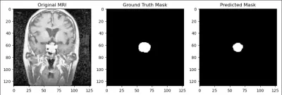 Brain Tumor Segmentation Using U-Net