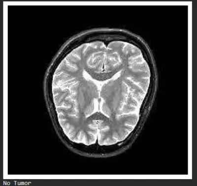 برمجة وتدريب نموذج ذكاء اصطناعي (Machine Learning) لاكتشاف وتصنيف أورام المخ