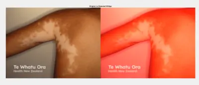 Vitiligo Detection using MATLAB