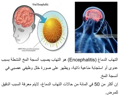 التهاب الدماغ