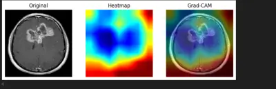 AI Based Brain Tumor Detection