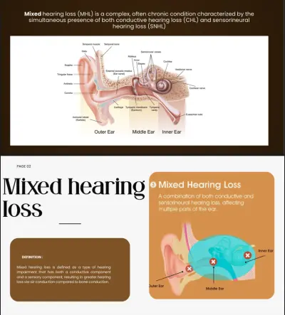 Mixed hearing loss PowerPoint