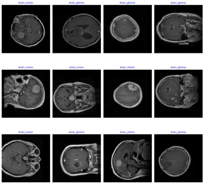 نظام ذكاء اصطناعي لتشخيص أورام المخ (MRI) بدقة عالية