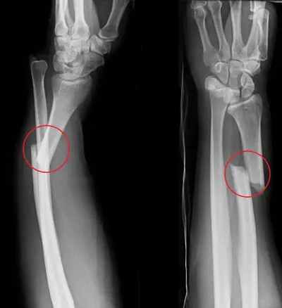 Bone Fracture Detection