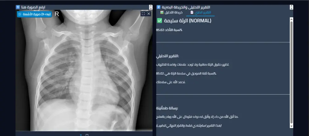 بناء نظام ذكاء اصطناعي (Deep Learning) للكشف عن الالتهاب الرئوي بالأشعة السينية.