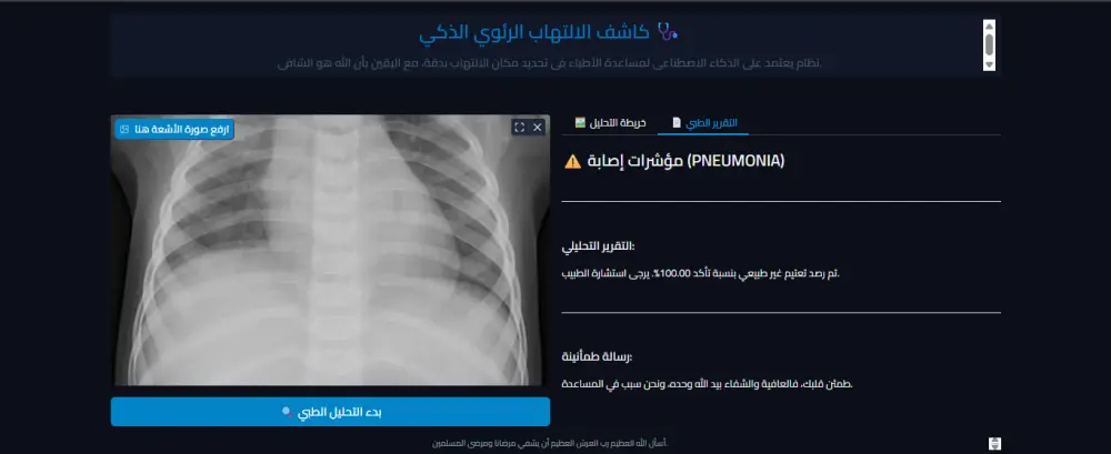 بناء نظام ذكاء اصطناعي (Deep Learning) للكشف عن الالتهاب الرئوي بالأشعة السينية.
