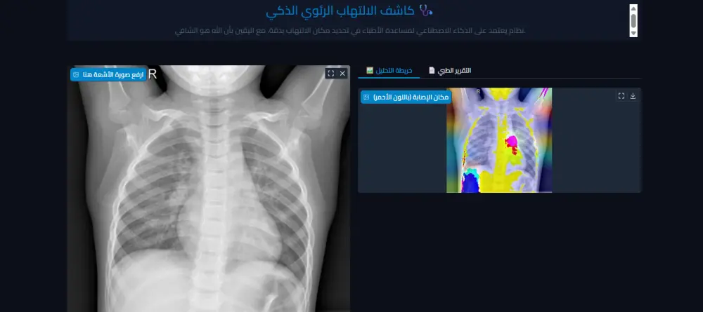 بناء نظام ذكاء اصطناعي (Deep Learning) للكشف عن الالتهاب الرئوي بالأشعة السينية.