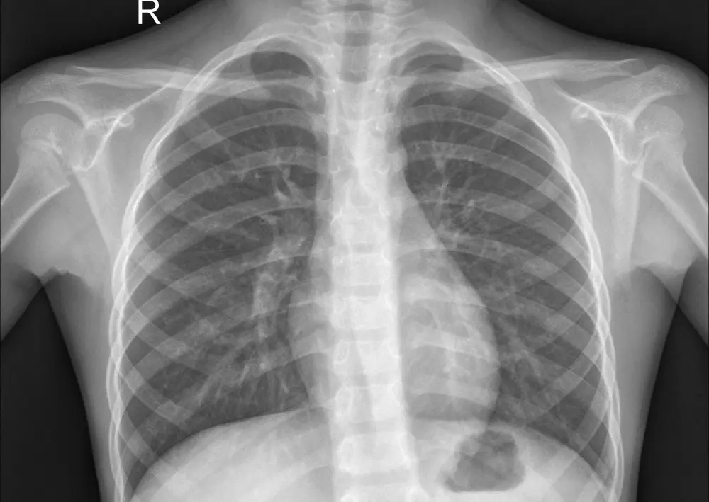 Pneumonia Detection