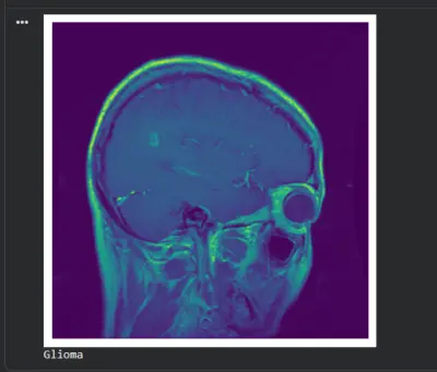 برمجة وتدريب نموذج ذكاء اصطناعي (Deep Learning) لاكتشاف وتصنيف أورام المخ